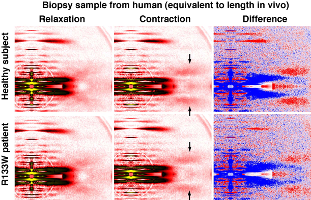 Fig. 4	X-Ray diffraction patterns of skeletal muscle (skinned fiber) obtained by biopsy from healthy subject and R133W patient