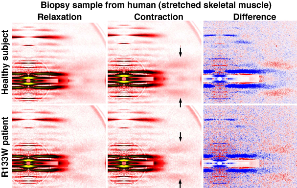 Fig. 5	X-Ray diffraction patterns of stretched skeletal muscle (skinned fiber) obtained by biopsy from healthy subject and R133W patient