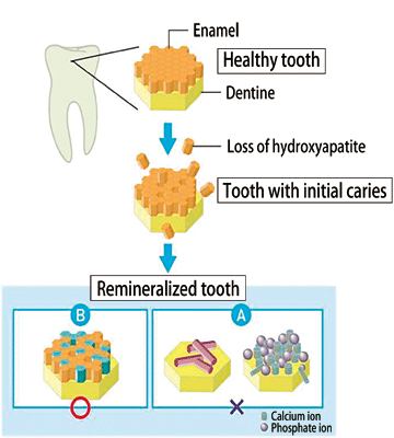 Fig. 5 Expected model of remineralization by POs-Ca.