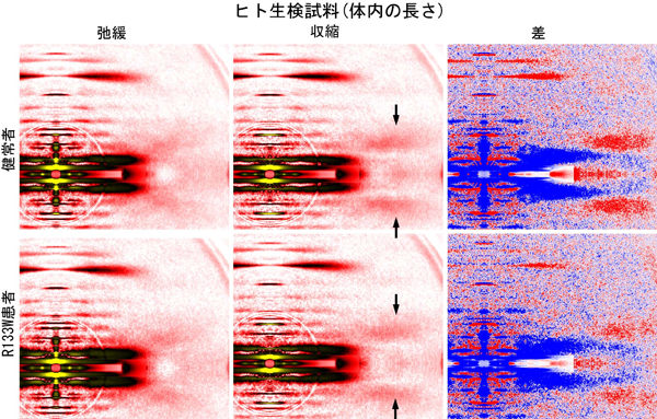 図4　健常者およびR133W患者から生検により採取した骨格筋細胞(スキンドファイバー)のX線回折像。