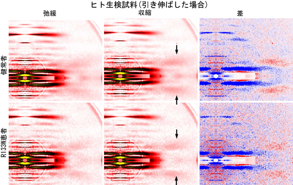 図5　健常者およびR133W患者から生検により採取した骨格筋細胞(スキンドファイバー)のX線回折像。