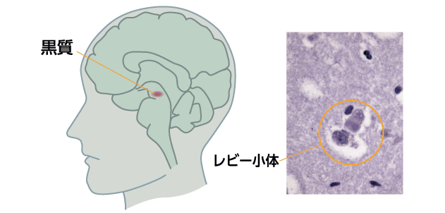 図1　黒質の位置（左）とレビー小体