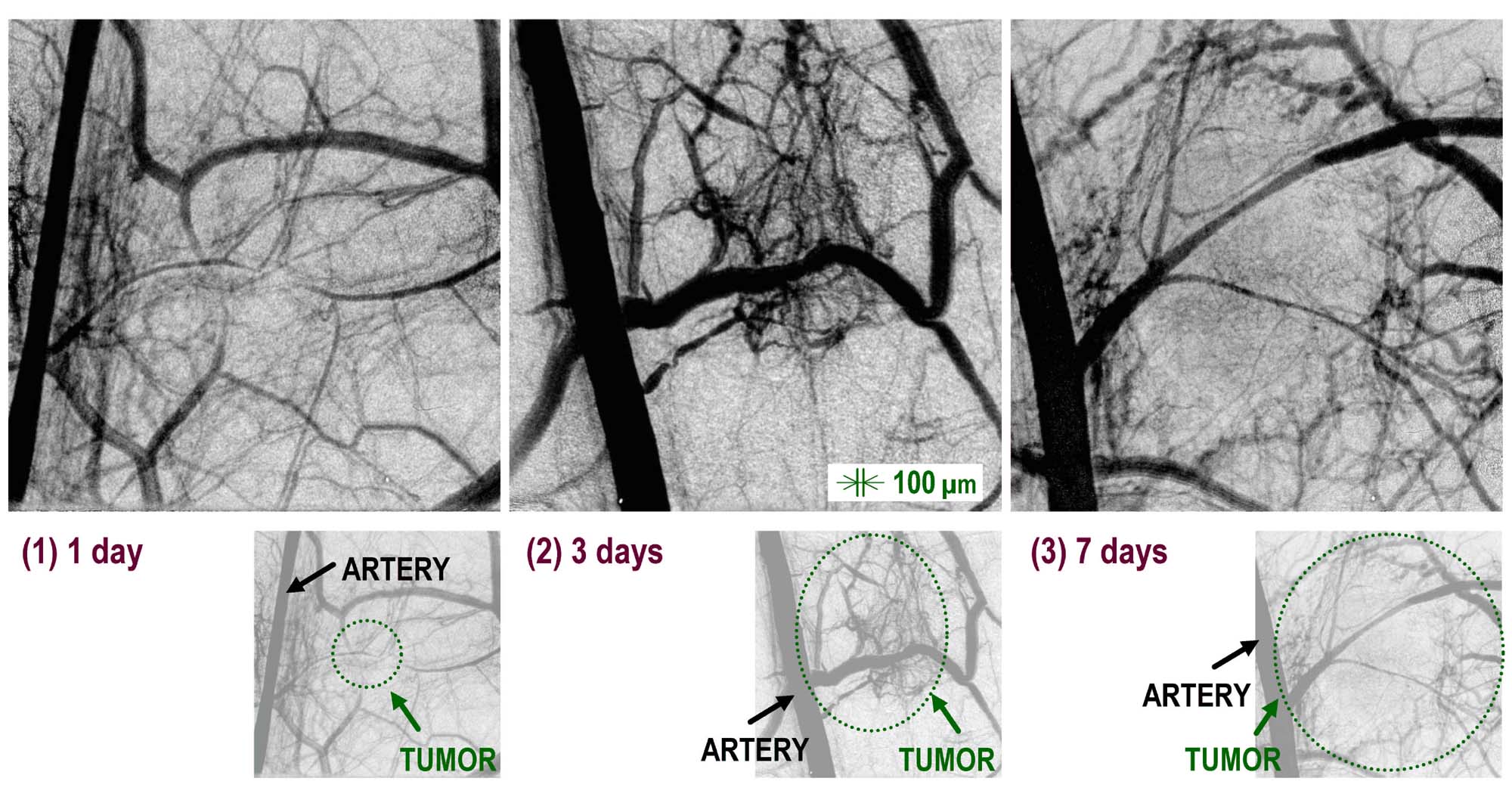 tumor2.jpg